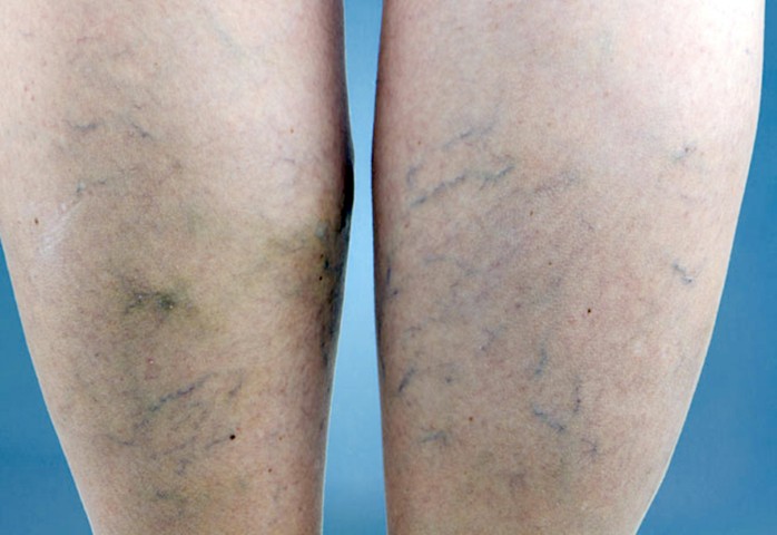 Varisin genellikle bacaklarda görülen bir damar hastalığı olduğunu belirten Uzmanlar,