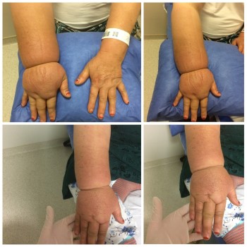 Çeşitli sebepler dolayısıyla kol ve bacaklarda oluşan şişliklerle ortaya çıkan