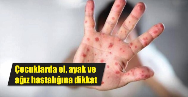 Uzmanlar, çocuklarda el, ayak ve ağız hastalıklarına dikkat edilmesi konusunda