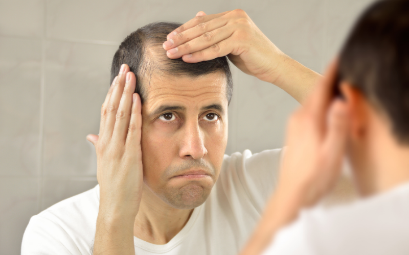 Erkek tipi saç dökülmesi tıbbi literatürde androgenetik alopesi olarak adlandırılmaktadır.